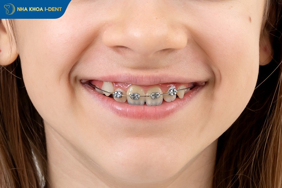 Niềng răng mắc cài kim loại