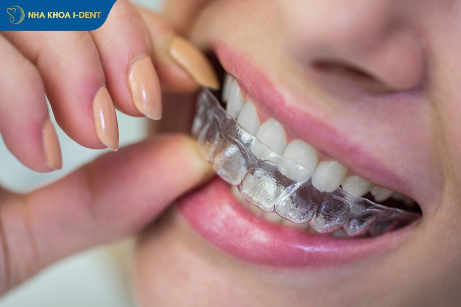 niềng răng nhanh nhất