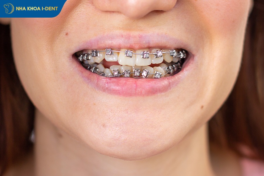 niềng răng nhanh