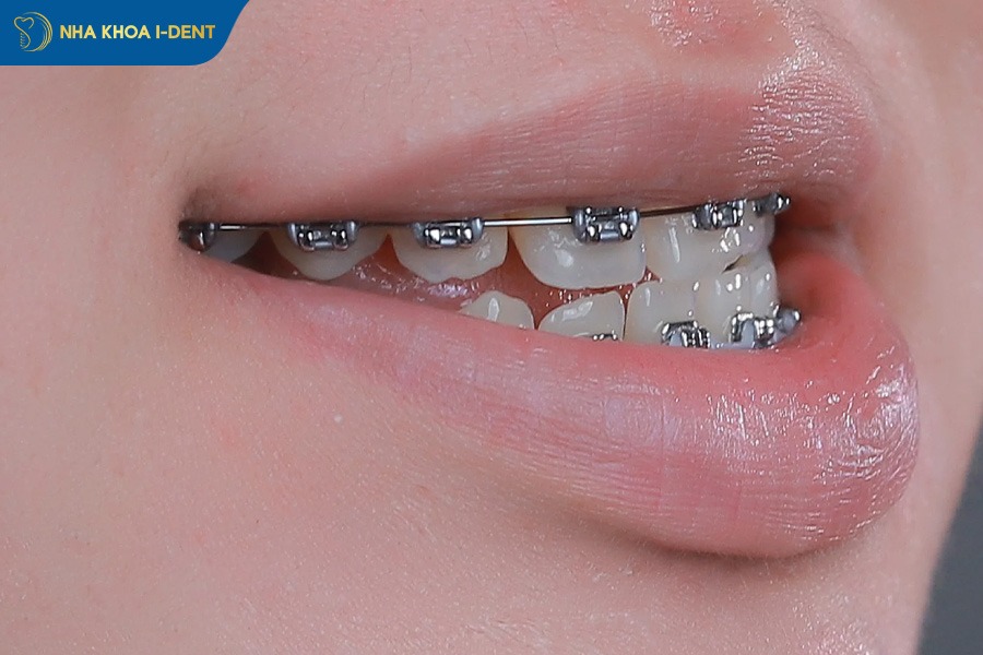 niềng răng xong bị móm