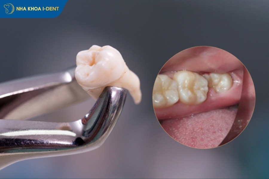 qua trình nhổ răng khôn