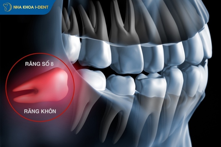 quy trình nhổ răng không