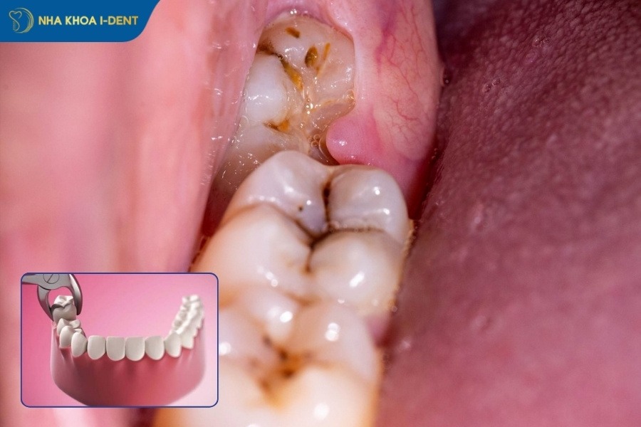 Răng khôn có cần nhổ không