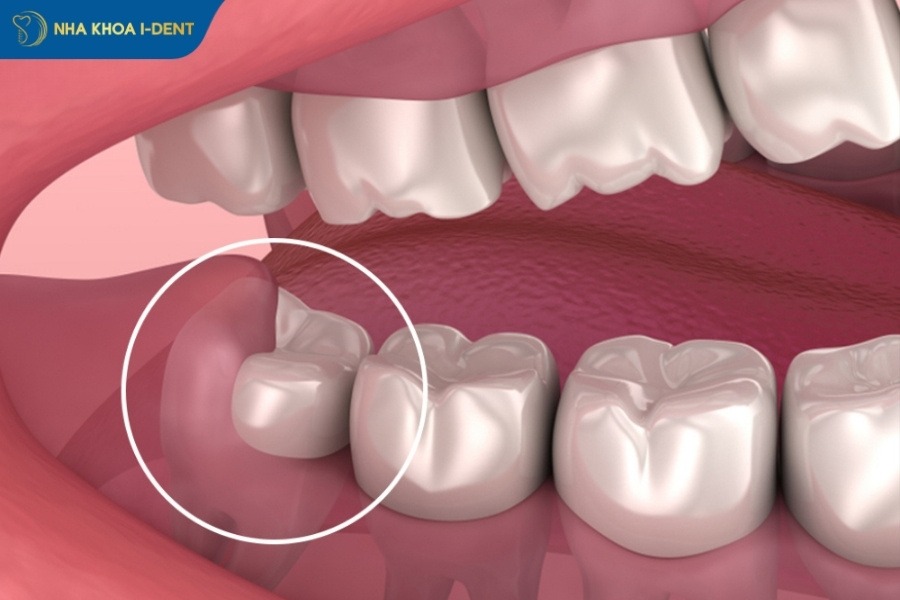 răng khôn có nên nhổ không