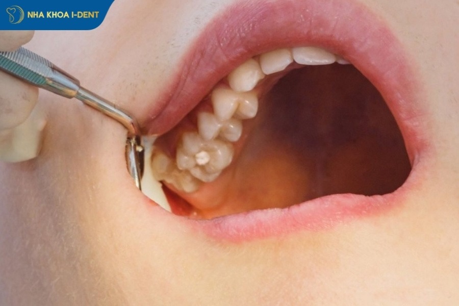 răng khôn có nên nhổ