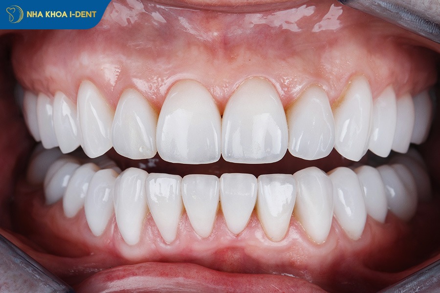 sứ kim loại và toàn sứ