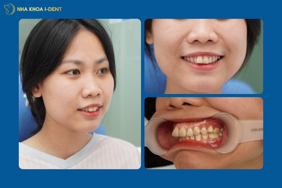 thời gian niềng răng nhanh nhất là bao lâu