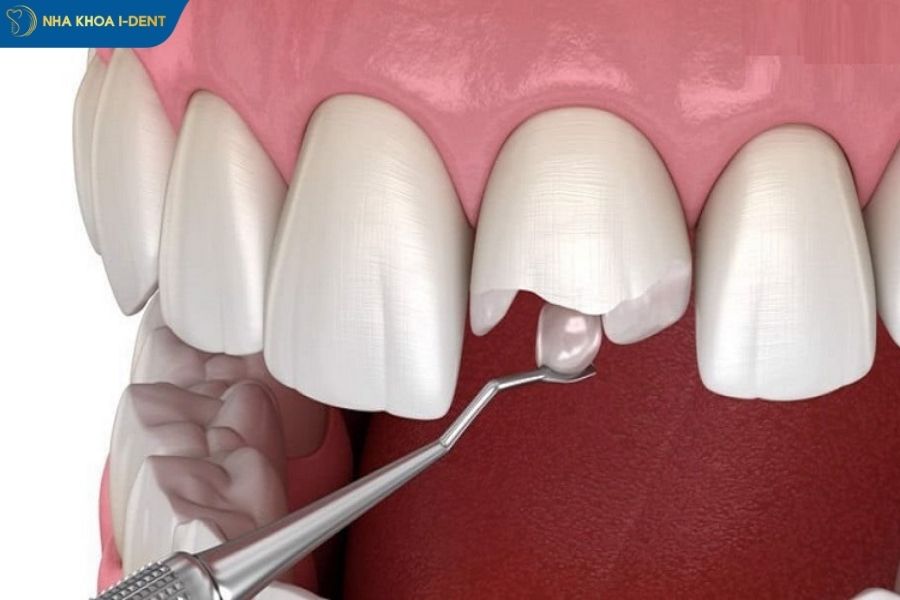 gãy răng cửa - Nha khoa I-Dent