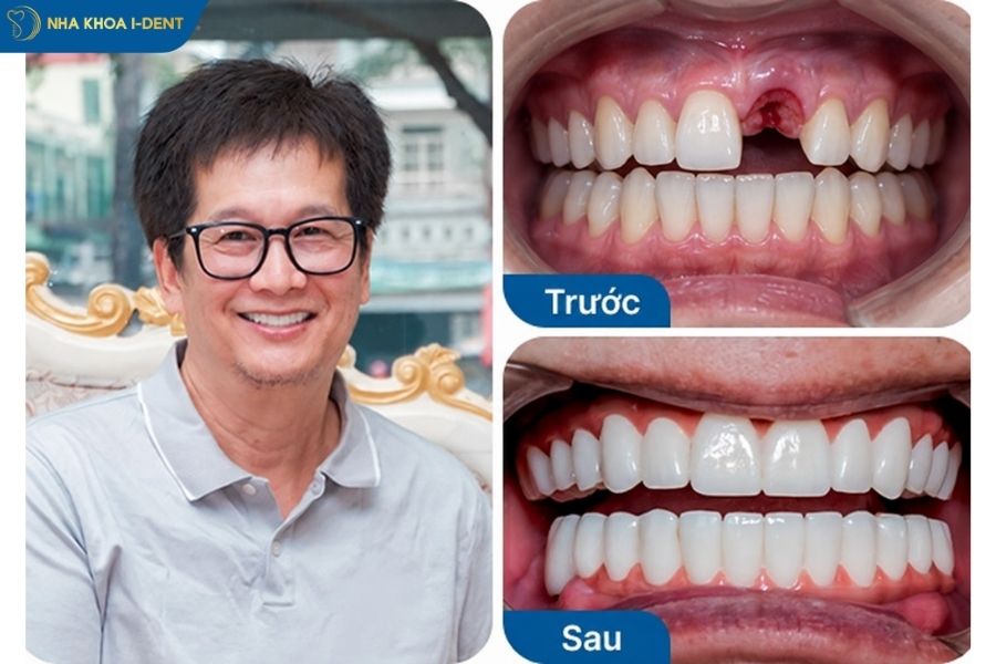 trồng răng cửa bị gãy - Nha khoa I-Dent