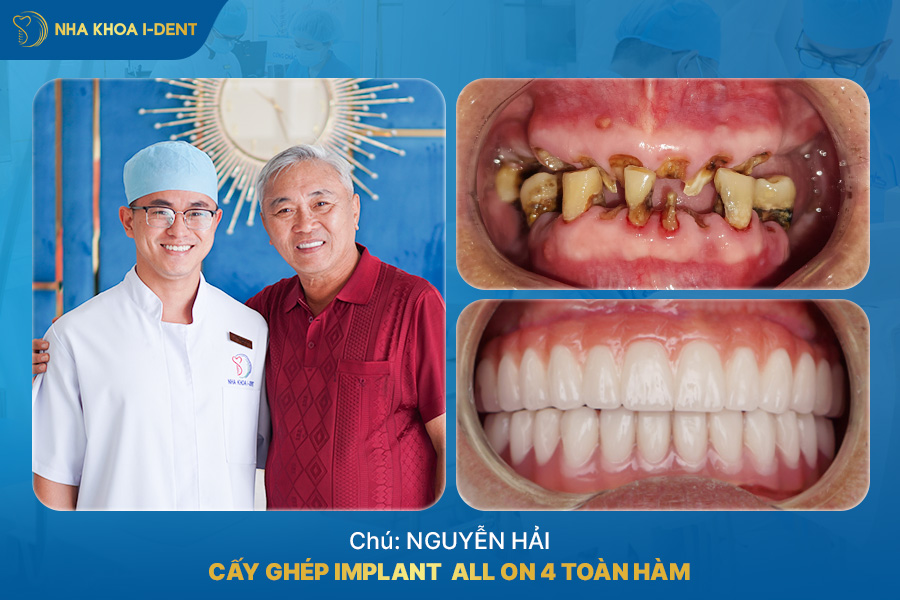 trồng răng đau không - Nha khoa I-Dent