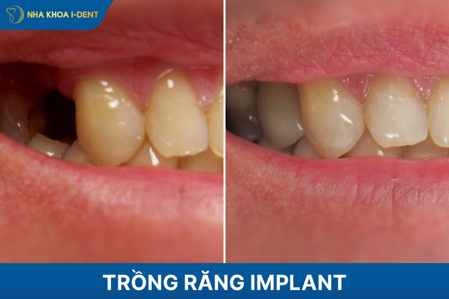 trồng răng implant