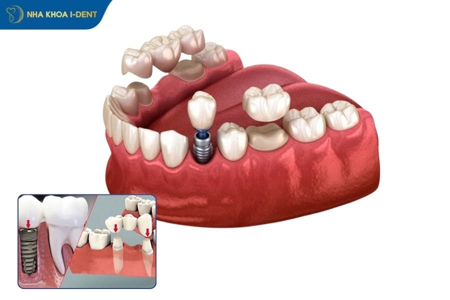 trồng răng sứ giá bao nhiêu 1 chiếc