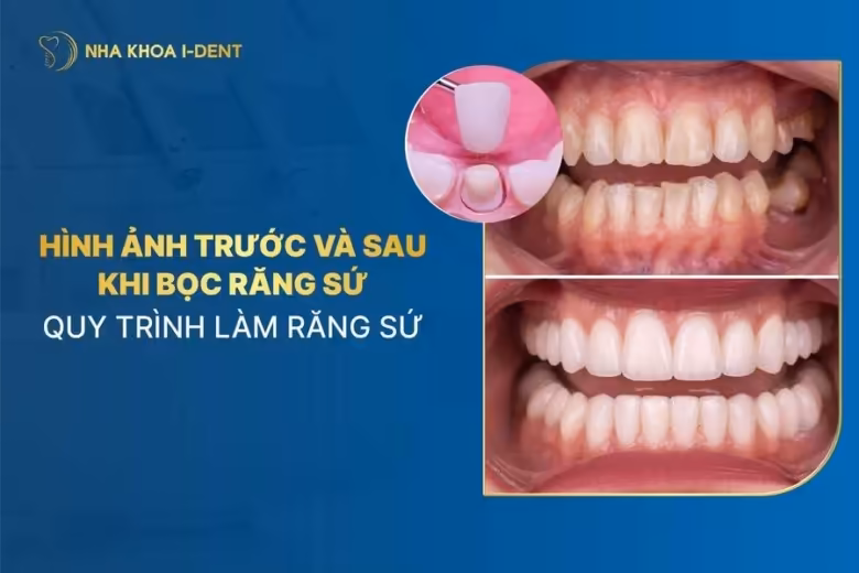 trước và sau khi làm răng sứ