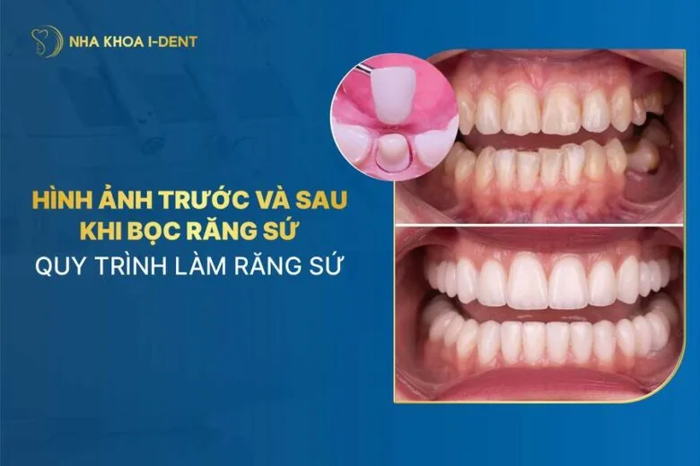 trước và sau khi làm răng sứ