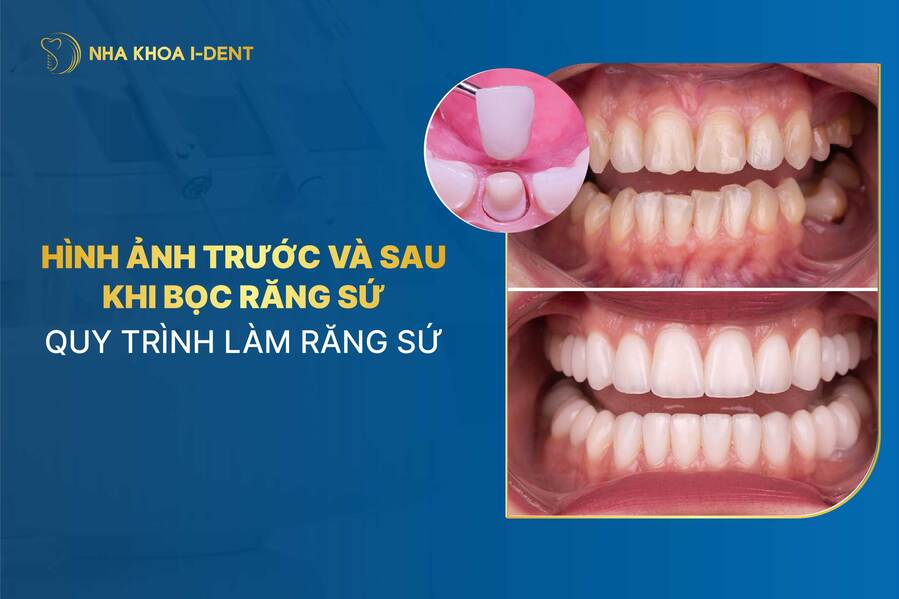 Hình ảnh trước và sau khi bọc răng sứ. Quy trình làm răng sứ