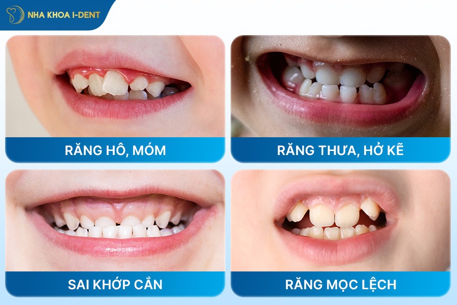 Trường hợp cần niềng răng cho bé 9 tuổi.