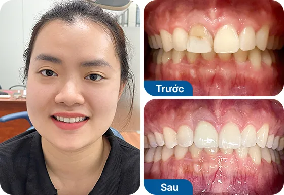 Chị Thùy Dương bọc sứ toàn hàm 12 răng tại nha khoa I-Dent.