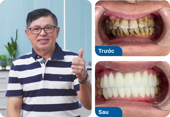 Chú Lê Chí Bình trồng răng Implant đơn lẻ