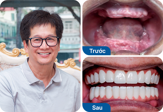 Chú Danny Văn Vũ trồng răng toàn hàm All-on-5 tại nha khoa I-Dent.