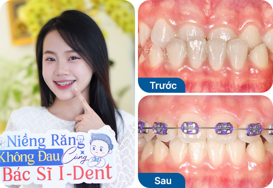 Chị Đỗ Huỳnh Linh Nhi đã niềng răng mắc cài kim loại tại nha khoa I-Dent.
