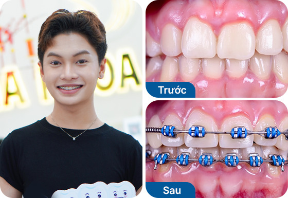 Anh Đức Thuận đã niềng răng mắc cài kim loại tại nha khoa I-Dent.