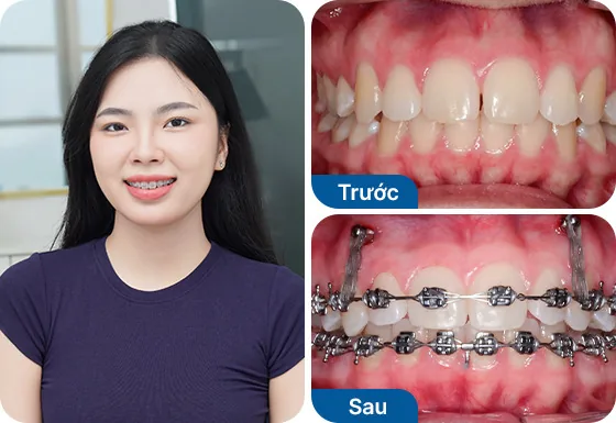 Chị Dương Hoàng Tú Uyên đã niềng răng mắc cài kim loại tại nha khoa I-Dent.