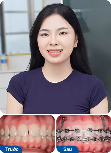 Bệnh nhân đã niềng răng tại nha khoa I-Dent.
