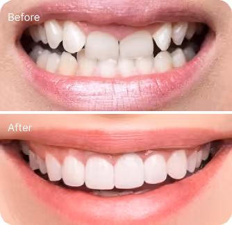 Khách hàng dán sứ veneer điều trị răng hô, móm nhẹ tại I-Dent.