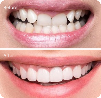 Khách hàng dán sứ veneer điều trị răng hô, móm nhẹ tại I-Dent.