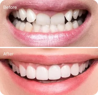 Khách hàng dán sứ veneer điều trị răng hô, móm nhẹ tại I-Dent.