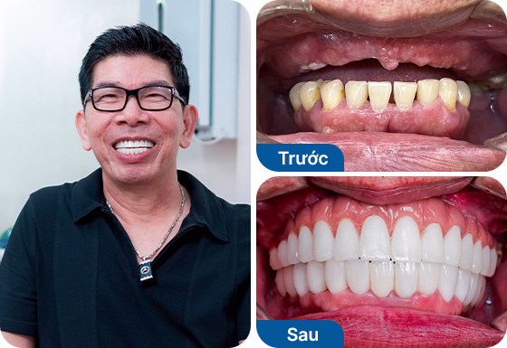 Chú Hùng Bùi trồng răng implant toàn hàm All-on-6 tại nha khoa I-Dent.