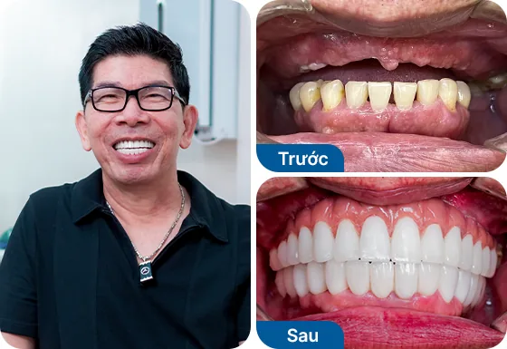 Chú Hùng Bùi trồng răng implant toàn hàm All-on-6 tại nha khoa I-Dent.
