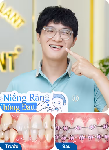 Bệnh nhân đã niềng răng tại nha khoa I-Dent.