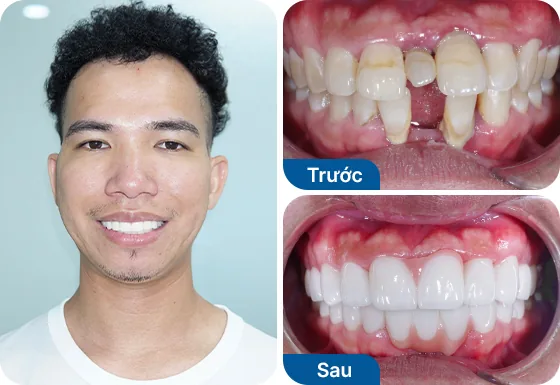 Anh Hoàng Huy bọc sứ 16 răng tại nha khoa I-Dent.