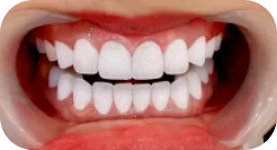 Dáng răng vuông