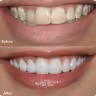 Bác sĩ nha khoa I-Dent phục hình sứ cho khách hàng.