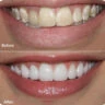 Bác sĩ nha khoa I-Dent phục hình sứ cho khách hàng.