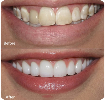 Khách hàng dán sứ veneer điều trị răng xỉn màu tại I-Dent.