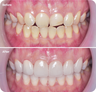 Khách hàng dán sứ veneer điều trị răng lệch lạc nhẹ tại I-Dent.