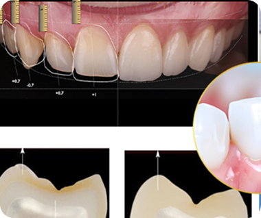Nha khoa I-Dent sử dụng máy CORiTEC 250i giúp chế tác răng sứ sát khít hoàn hảo.