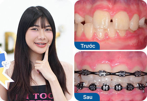 Chị Nguyễn Ngọc đã niềng răng mắc cài kim loại tại nha khoa I-Dent.