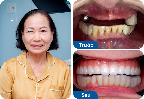 Cô Ngọc Hạnh trồng răng Implant All on 4 hàm trên tại nha khoa I-Dent.