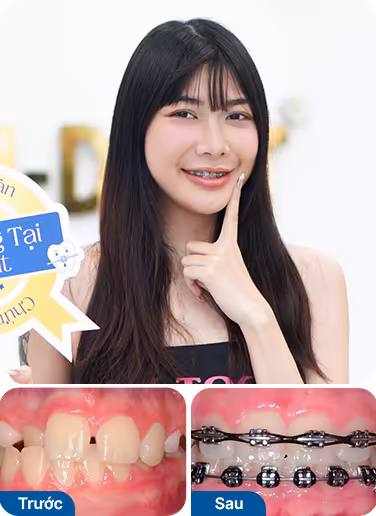 Bệnh nhân đã niềng răng tại nha khoa I-Dent.