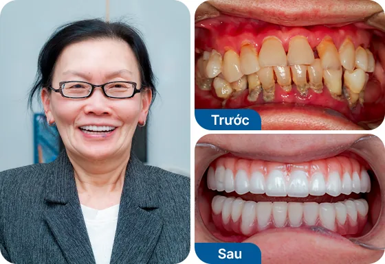 Cô Phương Nguyễn trồng răng Implant All on 4 2 hàm tại nha khoa I-Dent.