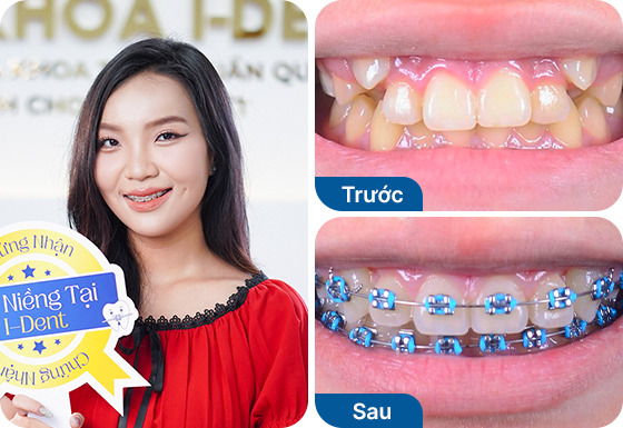 Chị Thủy Tiên niềng răng mắc cài kim loại tại nha khoa I-Dent.