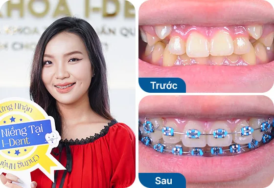Chị Thủy Tiên niềng răng mắc cài kim loại tại nha khoa I-Dent.