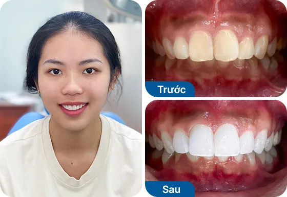 Chị Nguyễn Hữu bọc sứ toàn hàm 12 răng tại nha khoa I-Dent.