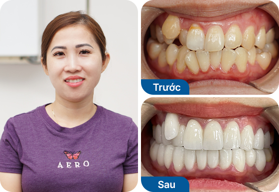 Chị Thúy Oanh bọc sứ toàn hàm 20 răng tại nha khoa I-Dent.