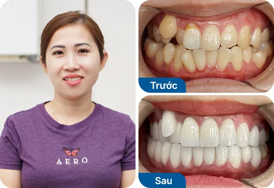 Chị Thúy Oanh bọc sứ toàn hàm 20 răng tại nha khoa I-Dent.