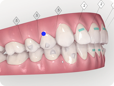 Niềng răng trong suốt Invisalign mang lại kết quả cải thiện rõ rệt chỉ sau 6 tháng niềng.